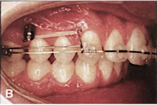 Figure 9 : Distalisation de l’arcade maxillaire. Initiation de la distalisation molaire par le biais d’un  élastique reliant l’ancrage squelettique à un jig coulissant (39)