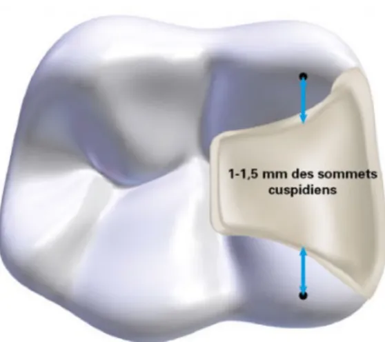 Figure n°7 : Vue schématique d’une cavité étendue de classe II   selon les recommandations du fabricant d’EQUIA Forte [50] 