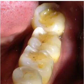 Figure 11. Erosion dentaire liée à une prise quotidienne de citron, chez une femme de 65 ans,  consommant depuis une vingtaine d’année