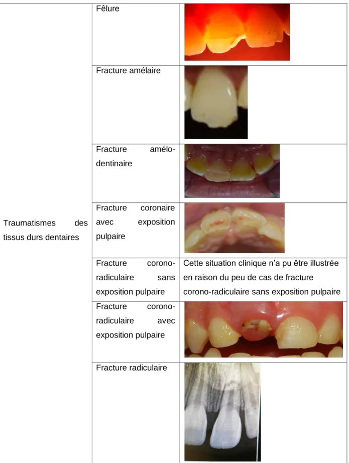 Tableau  1 : D’après  la  classification  d’Andreasen  des  traumatismes  des  tissus  durs  dentaires (Courtoisie du Dr Y