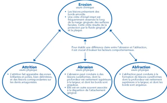 Figure   6   :   Diagnostic   différentiel   des   différentes   usures   (source   :   laboratoire   GABA)   