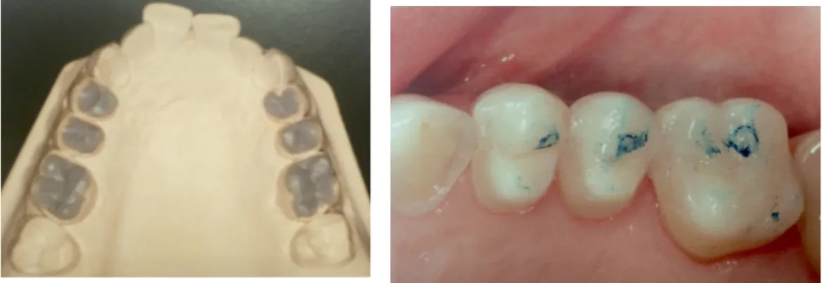 Figure   10   :   Mock   up   des   onlays   maxillaires   et   onlay   fabriqués   en   bouche   (25)    Une    fois    la    nouvelle    DV    validée,    on    a    l’espace    pour    les    facettes    palatines    (étape    2)