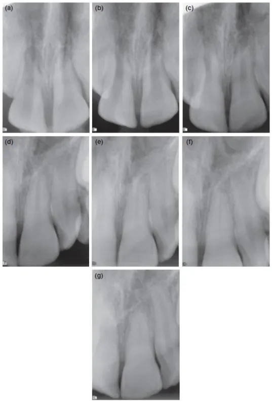 Figure 1 Rétrécissement sur 28 mois du canal d'une incisive centrale maxillaire suite à un choc (McCabe 2012) 