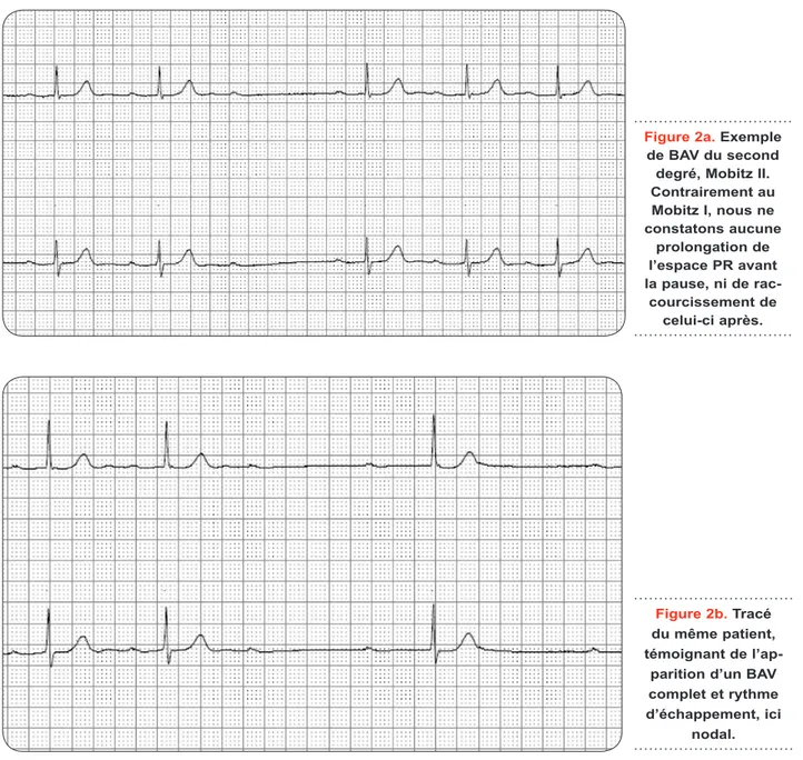 Figure 2a. Exemple  de BAV du second  degré, Mobitz II. 