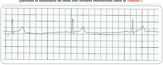 Figure 3. Exemple de BAV du second degré type 1:2. Ce tracé électrocardiographique ne   permet pas de classifier l’arythmie entre un BAV du second degré Mobitz I et Mobitz II,  