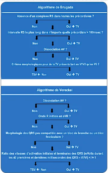 Tableau III. Algorithmes de Brugada et Vereckei  visant au diagnostic d’une tachycardie à  