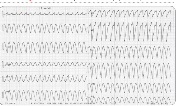 Figure 4. Exemple de tachycardie ventriculaire (TV)  monomorphe.