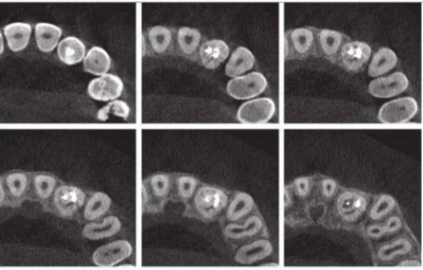 Figure 17. Traitement endodontique satisfaisant impossible dû à une morphologie complexe d'une dent invaginée
