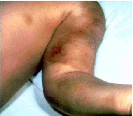 Figure 6 d'après Lasek (28): Hématomes du bras gauche chez un enfant  après avoir été maintenu trop fermement.