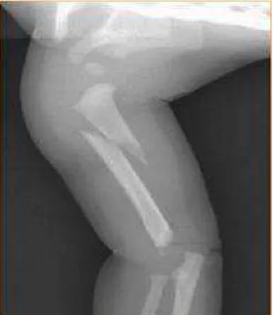 Figure 9 d'après Chateil (53): fracture diaphysaire avant l'âge de  la marche, signe évocateur de maltraitance.