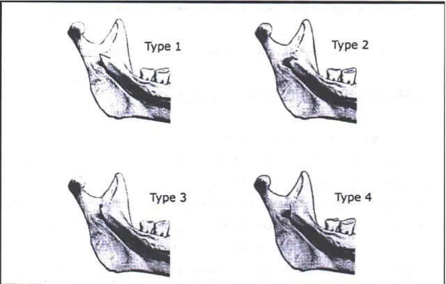 Figure 1 : Classification de la lingula selon 4 modalités morphologiques d’après TULI et al
