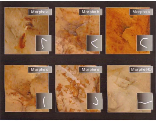 Figure 6 : Classification des morphes de la région de la lingula mandibulae d’après ROUAS (2007) (4)