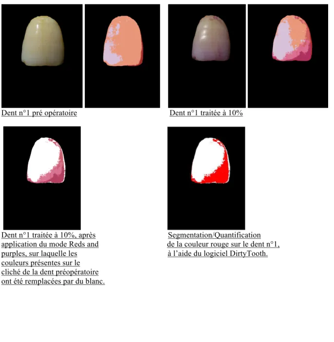 Figure n°4 : Application du mode Reds and Purples sur la dent n°1 et quantification. 