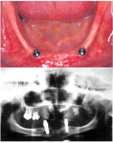 Figure 21 : Implants en position canine avec leur attachement boule  [8] [80] 