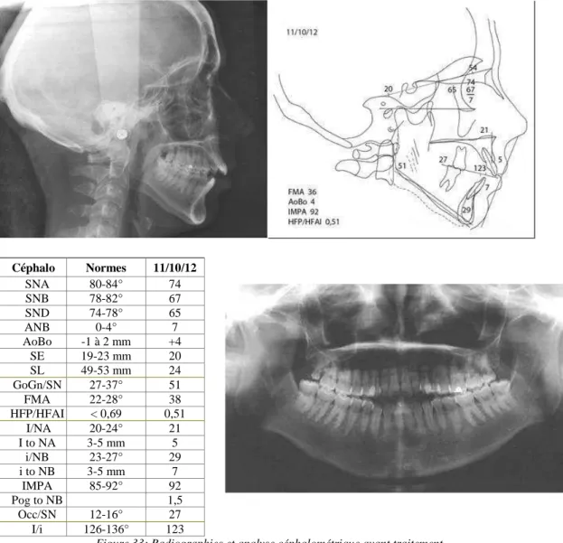 Figure 33: Radiographies et analyse céphalométrique avant traitement 