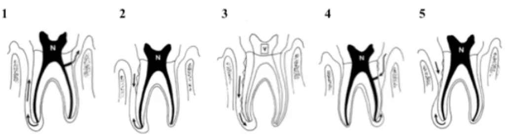 Figure 3 Classification de Simon et al (26) 