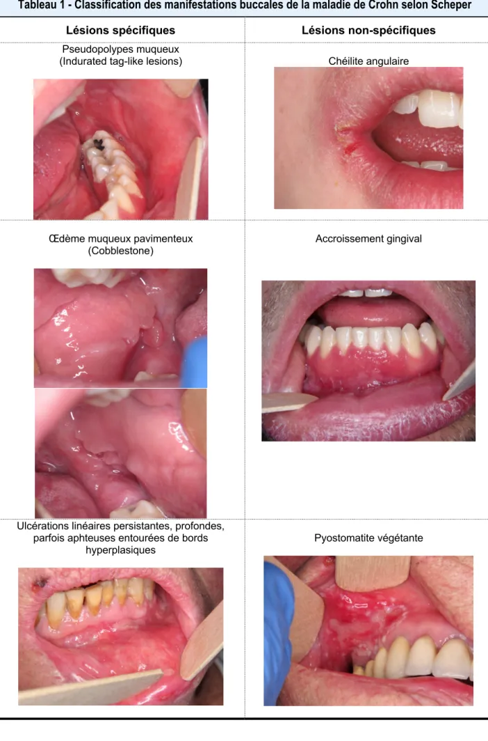 Tableau 1 - Classification des manifestations buccales de la maladie de Crohn selon Scheper