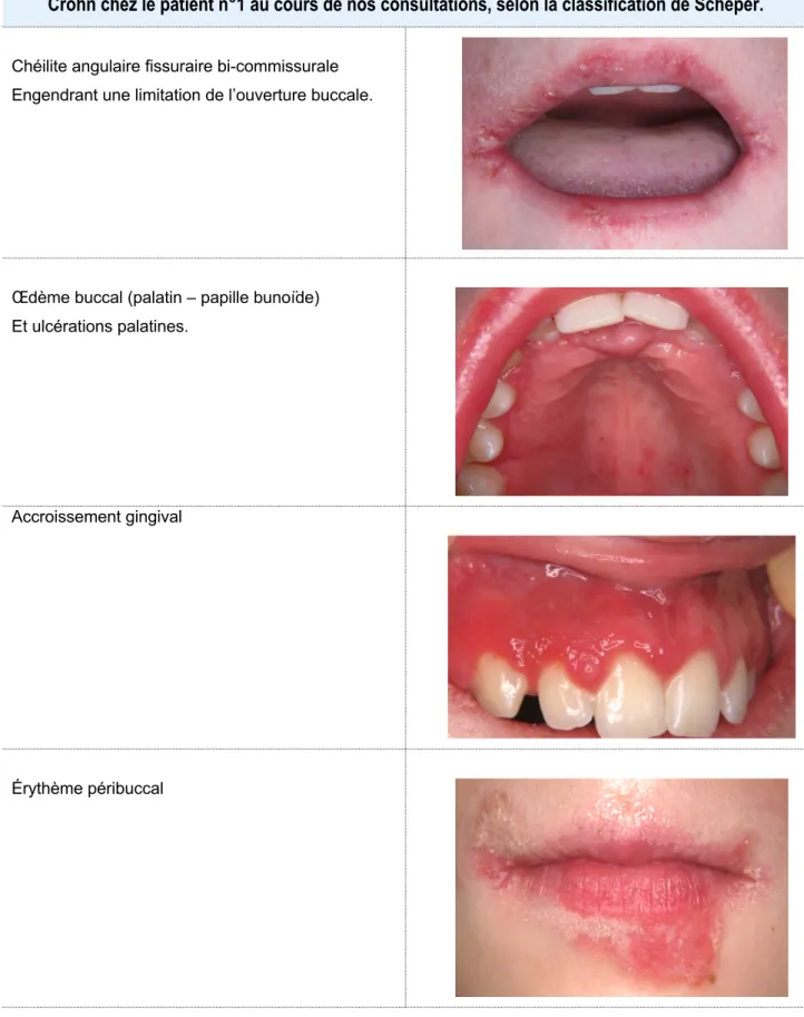 Tableau 3 – Synthèse de l’ensemble des manifestations orales non-spécifiques de la maladie de  Crohn chez le patient n°1 au cours de nos consultations, selon la classification de Scheper.