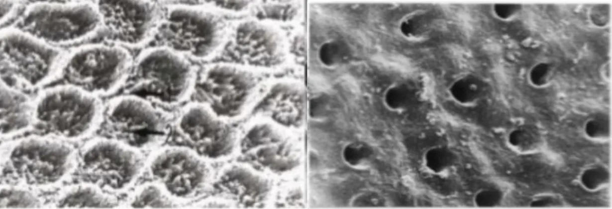 Figure 1 : Comparaison d’aspect entre les tubulis présents dans la dentine.  On note l’ouverture  large à droite avec l’aspect brut sans minéralisation secondaire (19) 