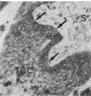 Fig. 3: Immunohistochemical localization of galectin-3 in a first trimester galectin-3 expression when polarized  CTBs (arrows) differentiate to form the trophoblastic cell column (TCC)