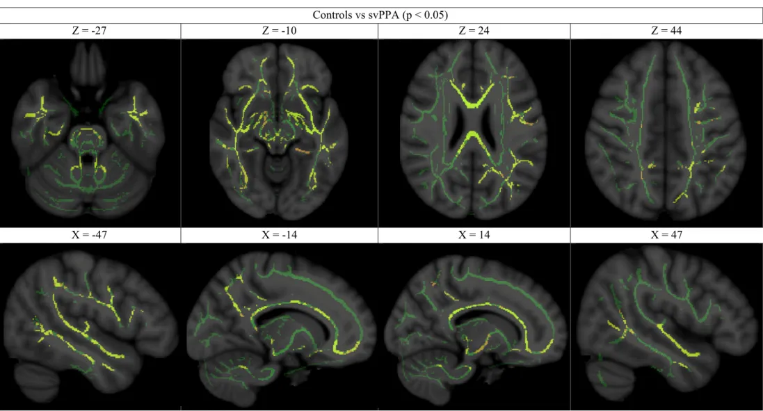 Figure 1. White matter maps: statistically significant difference of fractional anisotropy between svPPA patients and controls  Controls vs svPPA (p &lt; 0.05) 