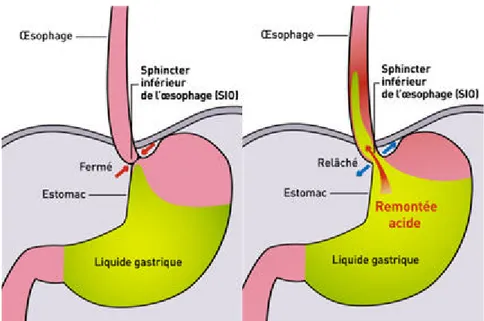 Figure 3 : Représentation d’un épisode de reflux acide par relaxation du sphincter inférieur de l'œsophage  (SIO) 
