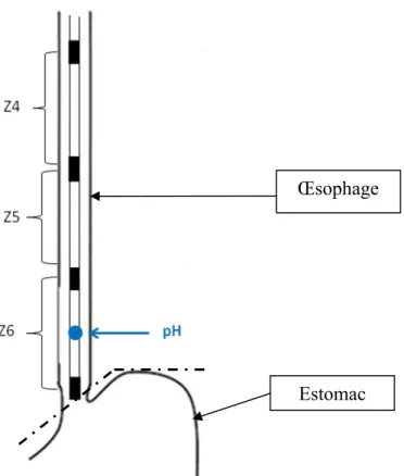 Figure 7. Position de la sonde d’impédancemétrie dans l’œsophage