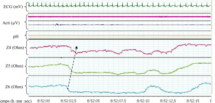 Figure 8. Exemple de tracé de pH-MII chez un nouveau-né avec le logiciel LabChart® (ADInstruments,  Bella Vista, Australia, la flèche indique le reflux rétrograde)