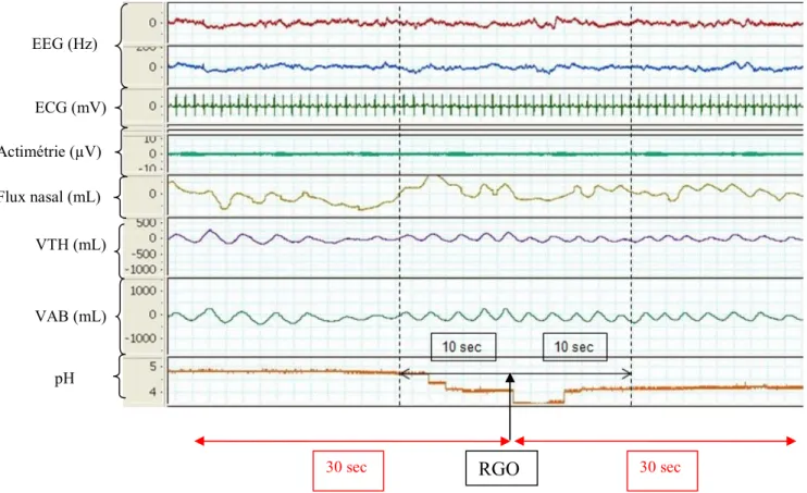 Figure 9. Représentation des périodes analysées : la période de référence avant le reflux et celle après le  reflux