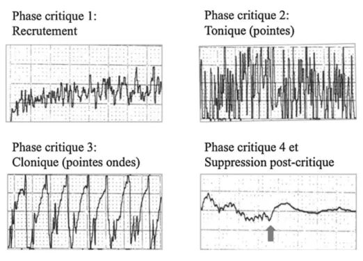 Figure 6. Présentation des quatre phases de la crise tonicoclonique induite par les ECT en EEG : recrutement,  tonique, clonique, fin de crise et suppression post-critique 
