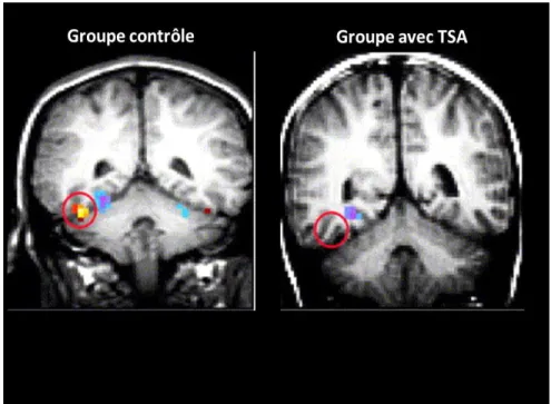 Figure 3 : Exemple d’absence d’activation de la FFA chez des personnes avec 