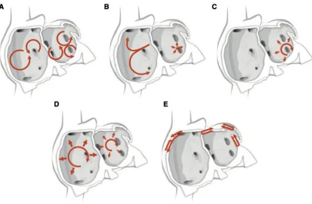 Figure 4 : Hypothèses physiopathologiques de la FA.(A) : vaguelettes multiples. (B) : Foci  ectopiques à décharges rapides