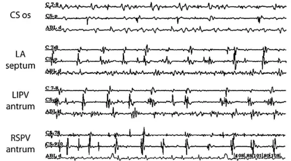 Figure 8 : Mise en évidence de CFAE : Electrogramme atrial fractionné complexe, avec plus de  2 déflexions ou perturbation prolongé de la ligne de base d'un EGM ; ou associé à un durée 