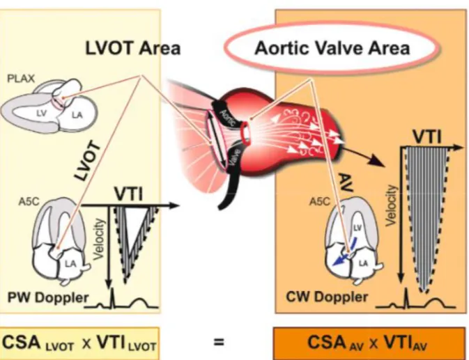 Figure 2 : Schéma du calcul de la surface valvulaire aortique par équation de continuité