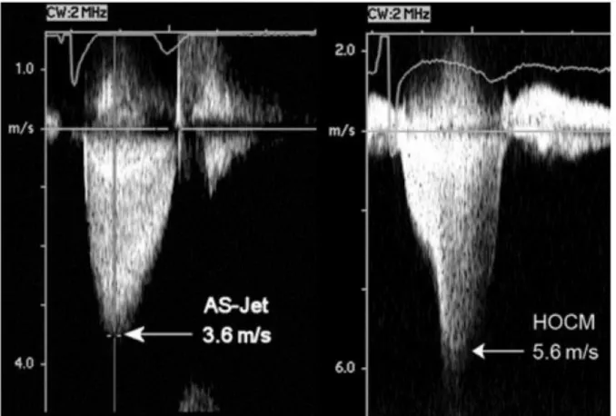 Figure 3: Sténose aortique  non serrée (gauche), flux d'obstruction dynamique d'une CMH  (droite) (source :   Recommendations on the echocardiographic assessment of aortic valve stenosis: a  focused update from the European Association of Cardiovascular Im