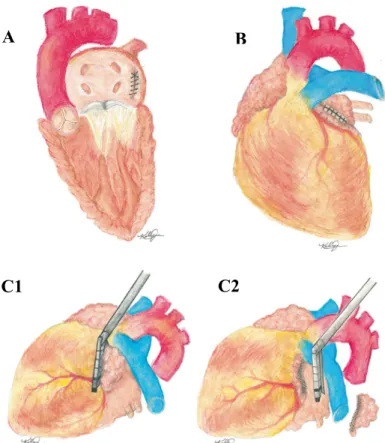 Figure 5 : Exemples de fermetures d’auricule chirurgicales : Suture endocardique  (A), Suture épicardique (B), Mise en place des agrafes chirurgicales (C1) puis  exérèse de l’auricule gauche (C2)