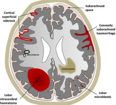 Figure 7 : Représentation schématique des manifestations hémorragiques et  ischémiques de l'angiopathie amyloïde cérébrale sporadique, visible à l'IRM 28 
