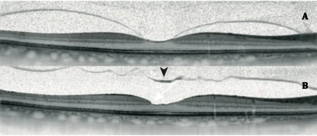 Figure  7 :  Adhésion  vitréo-maculaire  (AVM) :  évolution  naturelle.  A :  AVM  focale 