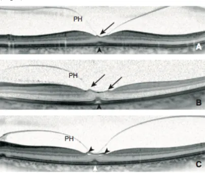 Figure 8 : Différents degrés de modifications précoces du tissu fovéolaire dans les yeux  controlatéraux de TM