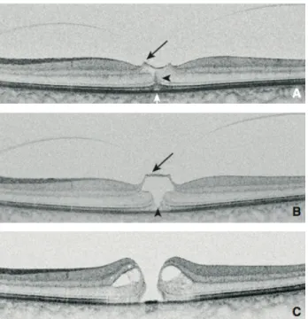 Figure 9 : Évolution d’une TVM vers un TM de pleine épaisseur. A : TVM focale.      B :  Quatre mois après, aggravation de la TVM avec élévation du plancher fovéolaire