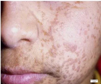 Figure 11 : Verrues planes sur le visage 