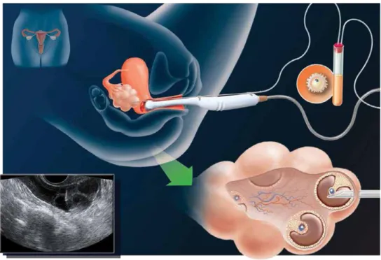 Figure 4 : Déroulement de la ponction ovarienne. (J. Herrero Garcia, EMD Serono, Canada)  e)  Le recueil des spermatozoïdes