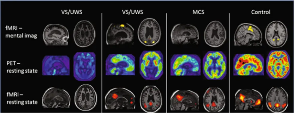 Fig. 8 From [31]. Glucose metabolism as measured with FDG positron emission tomography, BOLD resting state default mode network activity and BOLD mental imagery as measured with functional MRI in different states of consciousness