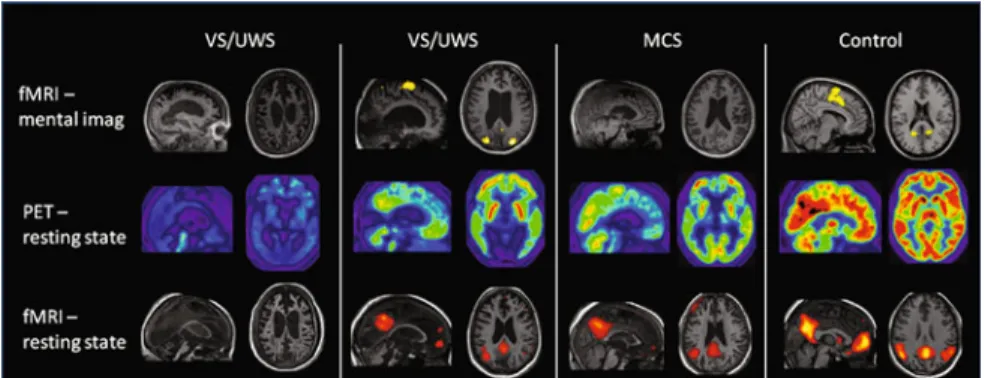 Fig. 8 From [31]. Glucose metabolism as measured with FDG positron emission tomography, BOLD resting state default mode network activity and BOLD mental imagery as measured with functional MRI in different states of consciousness