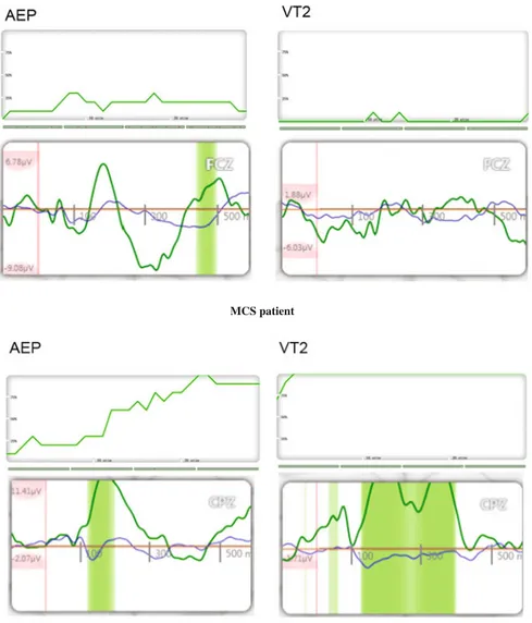 Fig. 2 AEP and VT2 results for one UWS (unresponsive wakefulness state) and one MCS (minimally conscicousness state) patient