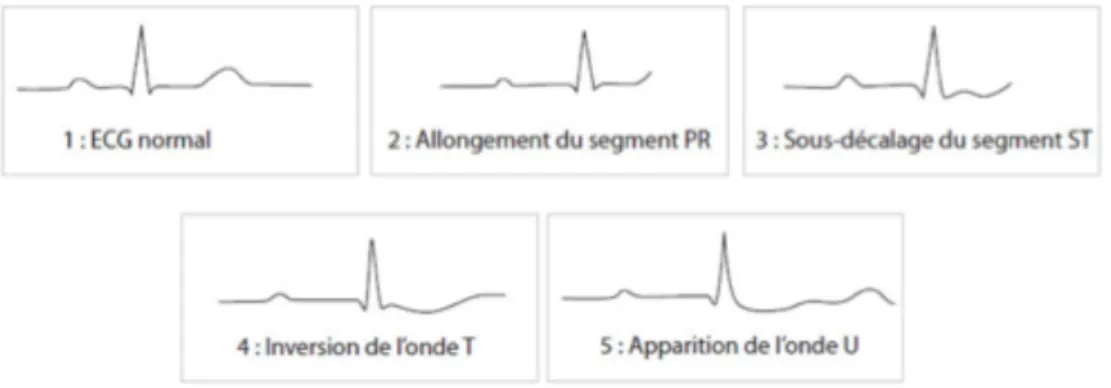 Figure 11 : Signes électrocardiographiques de l’hypokaliémie  
