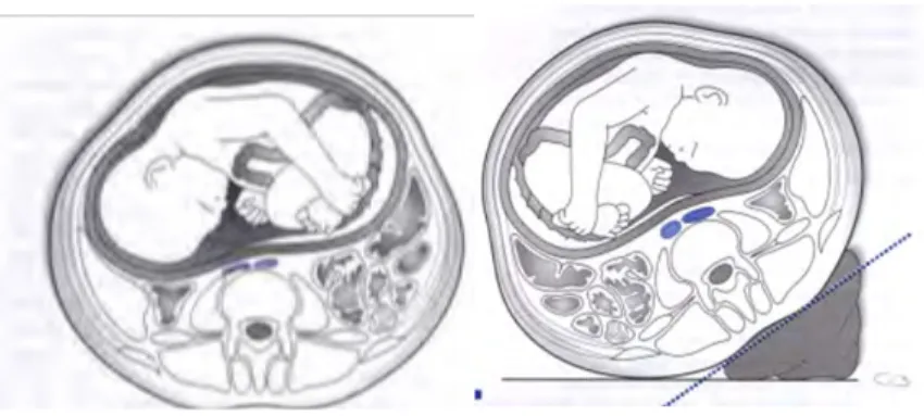 Figure 6 Illustration d'une compression aorto-cave(26) 