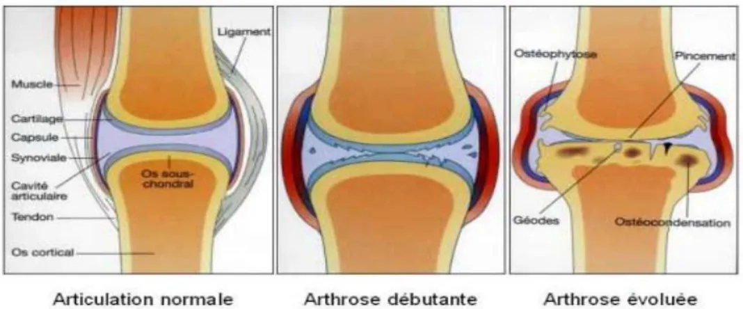 Figure 4 : De l’articulation normale à l’arthrose [28] 