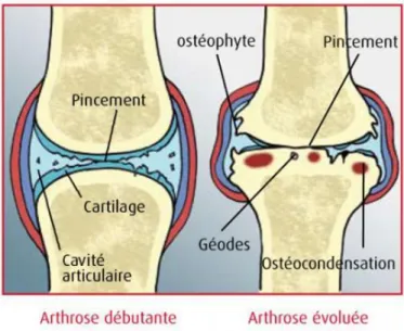 Figure 5 : Dégradation de l’os sous-chondral au cours de l’arthrose [30] 