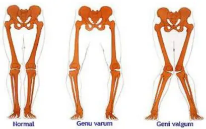 Figure 8 : Genu varum / Genu valgum  [38] 